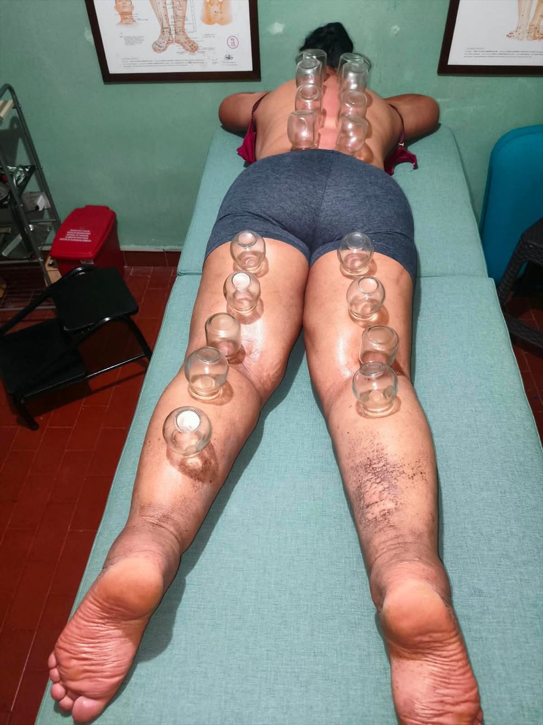 Ventosas sobre la espalda y las piernas en una sesión de medicina china